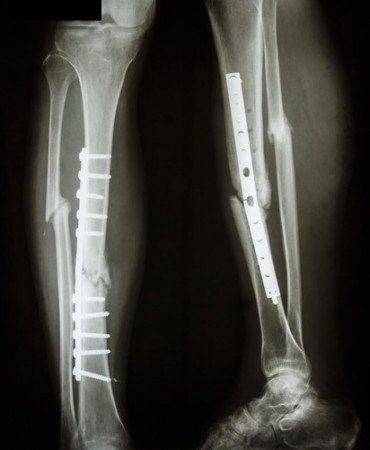 Tíbia e fíbula fraturadas (ossos da canela), após cirurgia para inserção de placa e parafusos. Foto: Puwadol Jaturawutthichai / Shutterstock.com