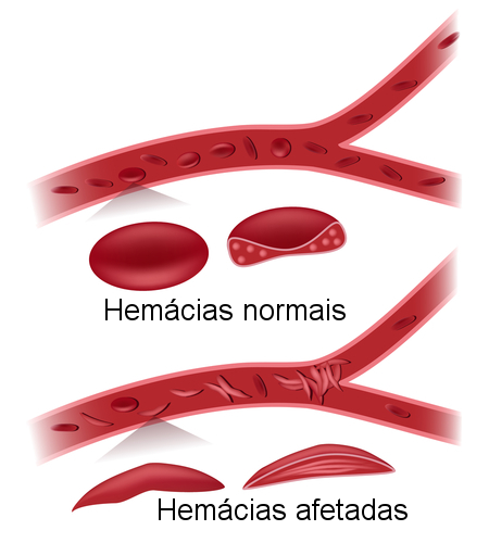 Hemácias normais e afetadas pela anemia falciforme. Ilustração: Alila Medical Media / Shutterstock.com