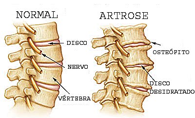 Artroza vertebrală spondilartroză