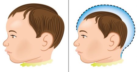 Criança normal e outra com microcefalia. Ilustração: Luciano Cosmo / Shutterstock.com