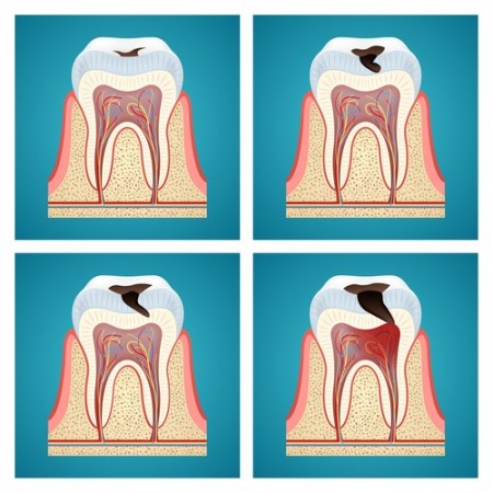 Evolução de uma cárie dentária. Ilustração: Maxi_m / Shutterstock.com