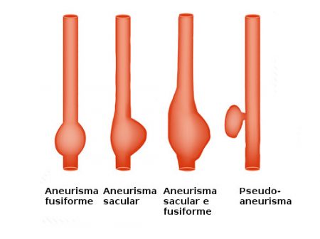 Tipos de aneurismas. Ilustração: Timonina / Shutterstock.com