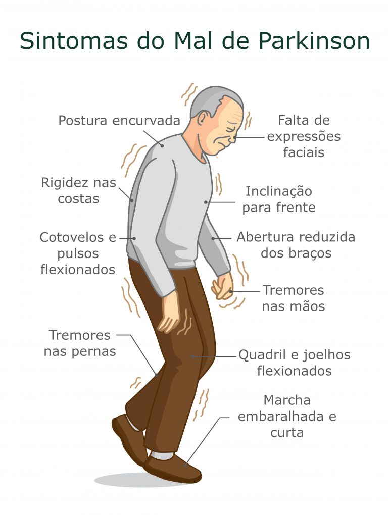 Mal de Parkinson - causas, sintomas, tratamentos - Doenças - InfoEscola
