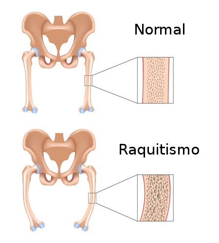 Raquitismo. Ilustração: Alila Medical Media / Shutterstock.com