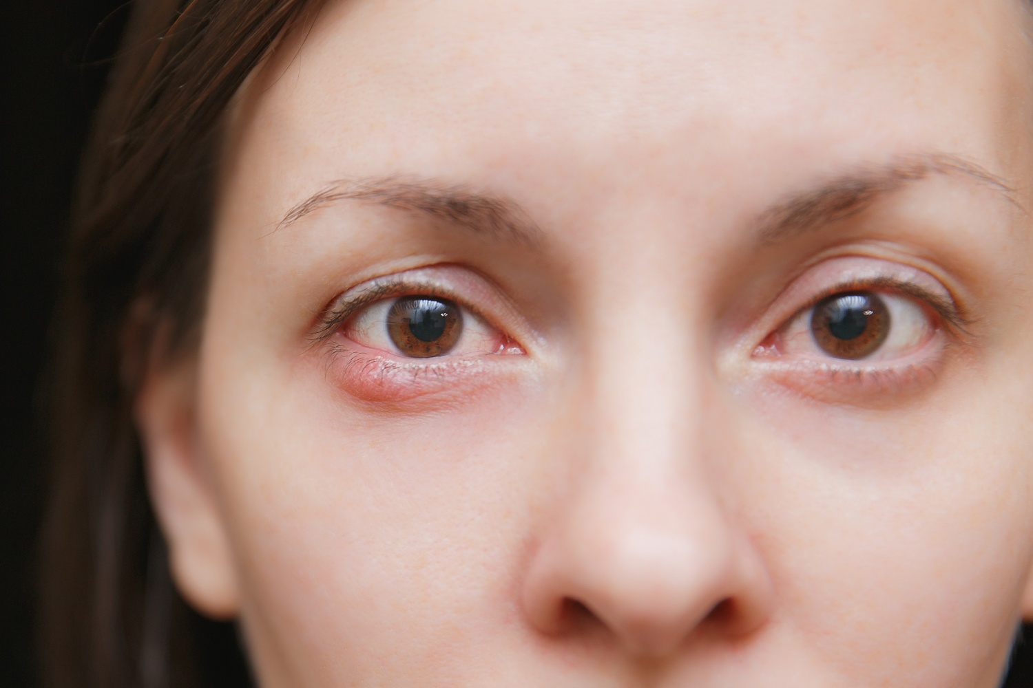 Jovem mulher com doença de Hordéolo no olho, Banco de Video