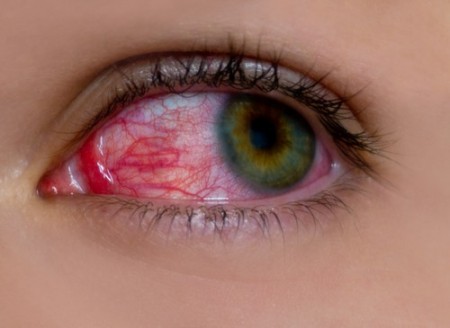 Hiperemia ocular. Foto: Sergii Chepulskyi / Shutterstock.com