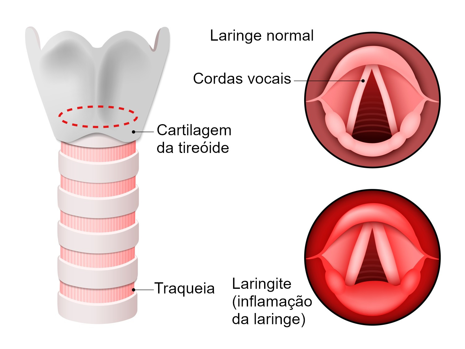 Лечение голосовых. Заболевания гортани острый ларингит. Острый ларингит – воспаление гортани;. Острый ларингит у детей симптомы. Острый ларингит ларингоскопия.