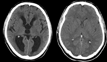 Tomografia computadorizada mostrando hidrocefalia (à esquerda), e um cérebro normal (direita). Foto: MBq [Public domain], via Wikimedia Commons