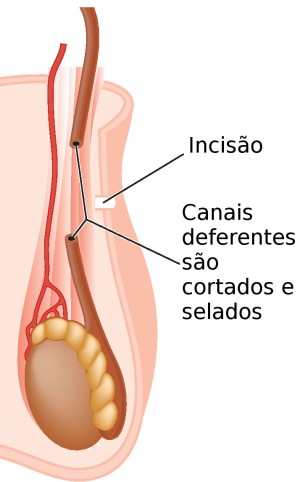 Vasectomia. Ilustração: Blamb / Shutterstock.com