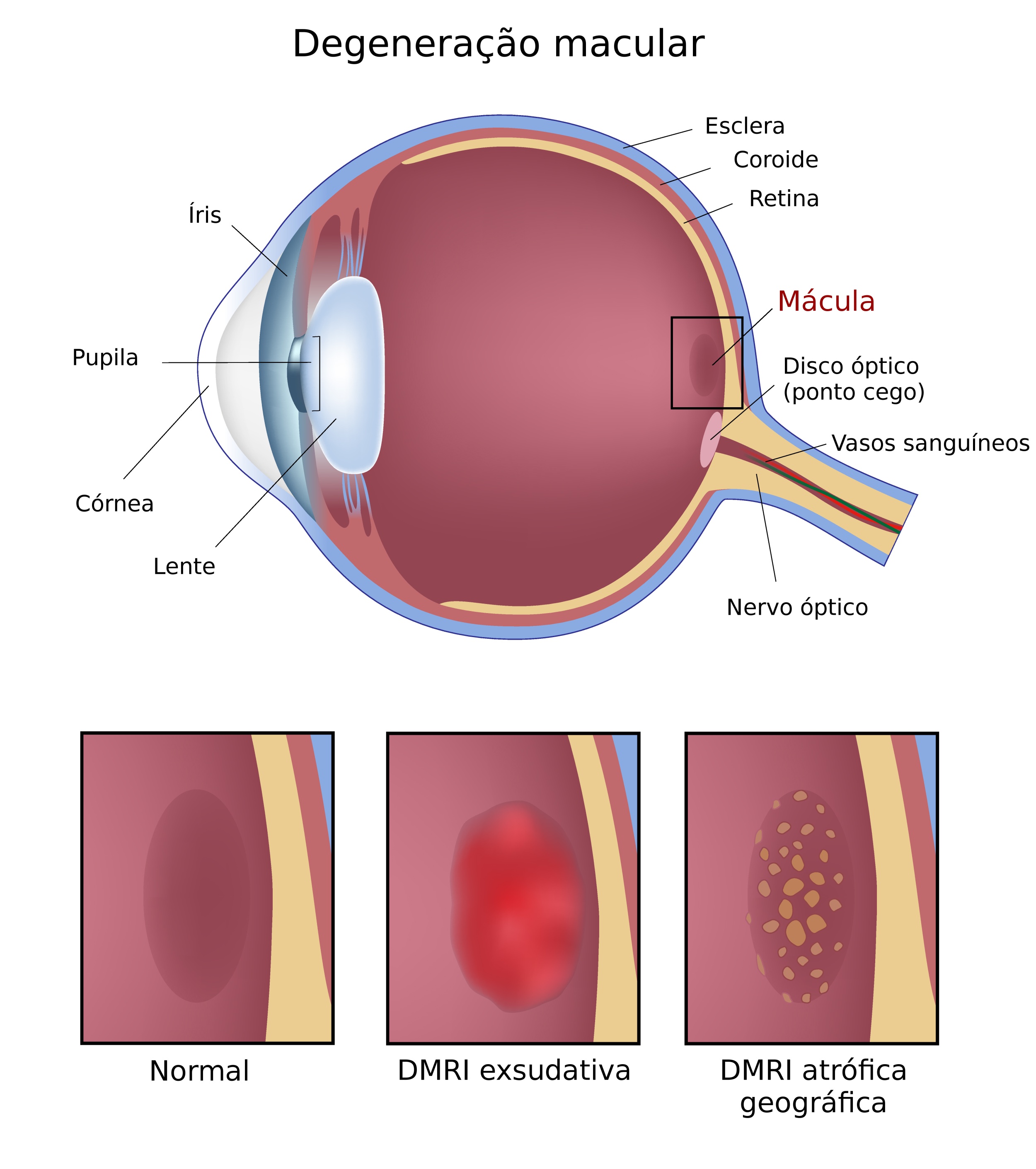 Considerações gerais sobre doenças da retina - Distúrbios