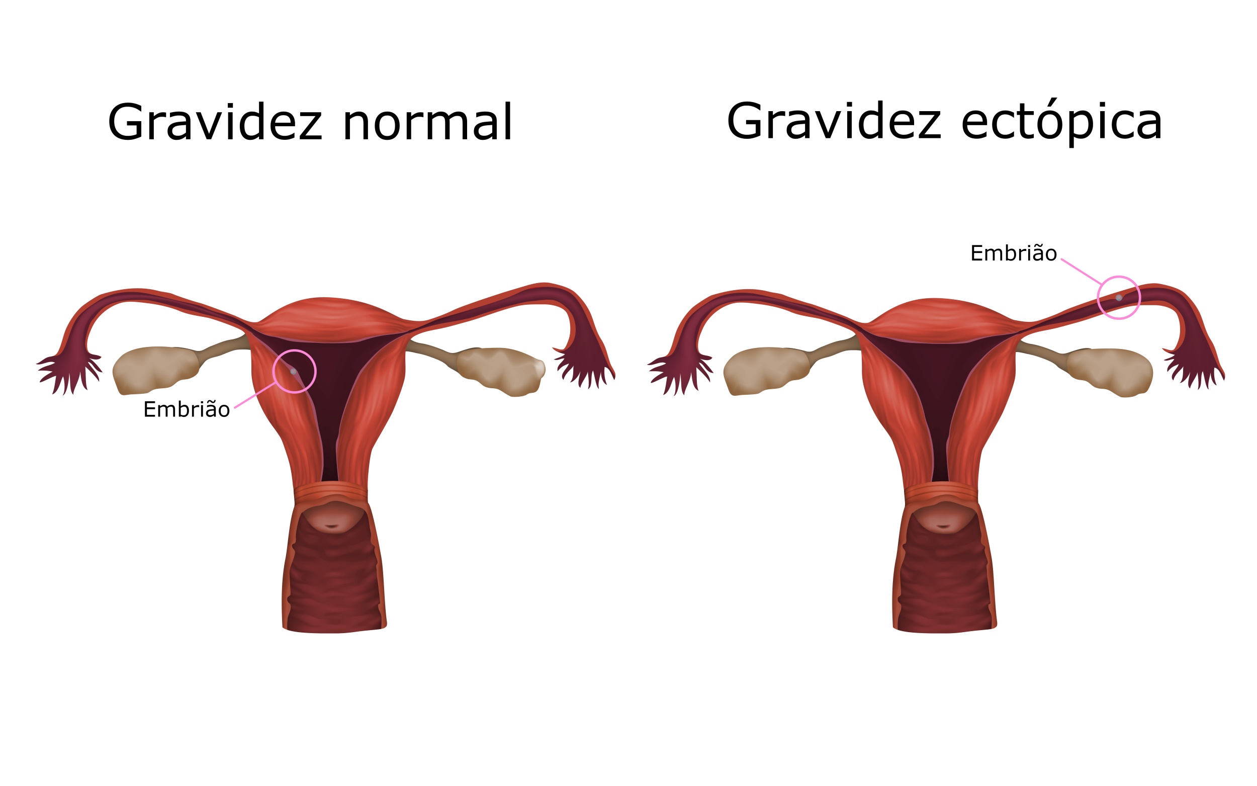 Resumo sobre gravidez ectópica