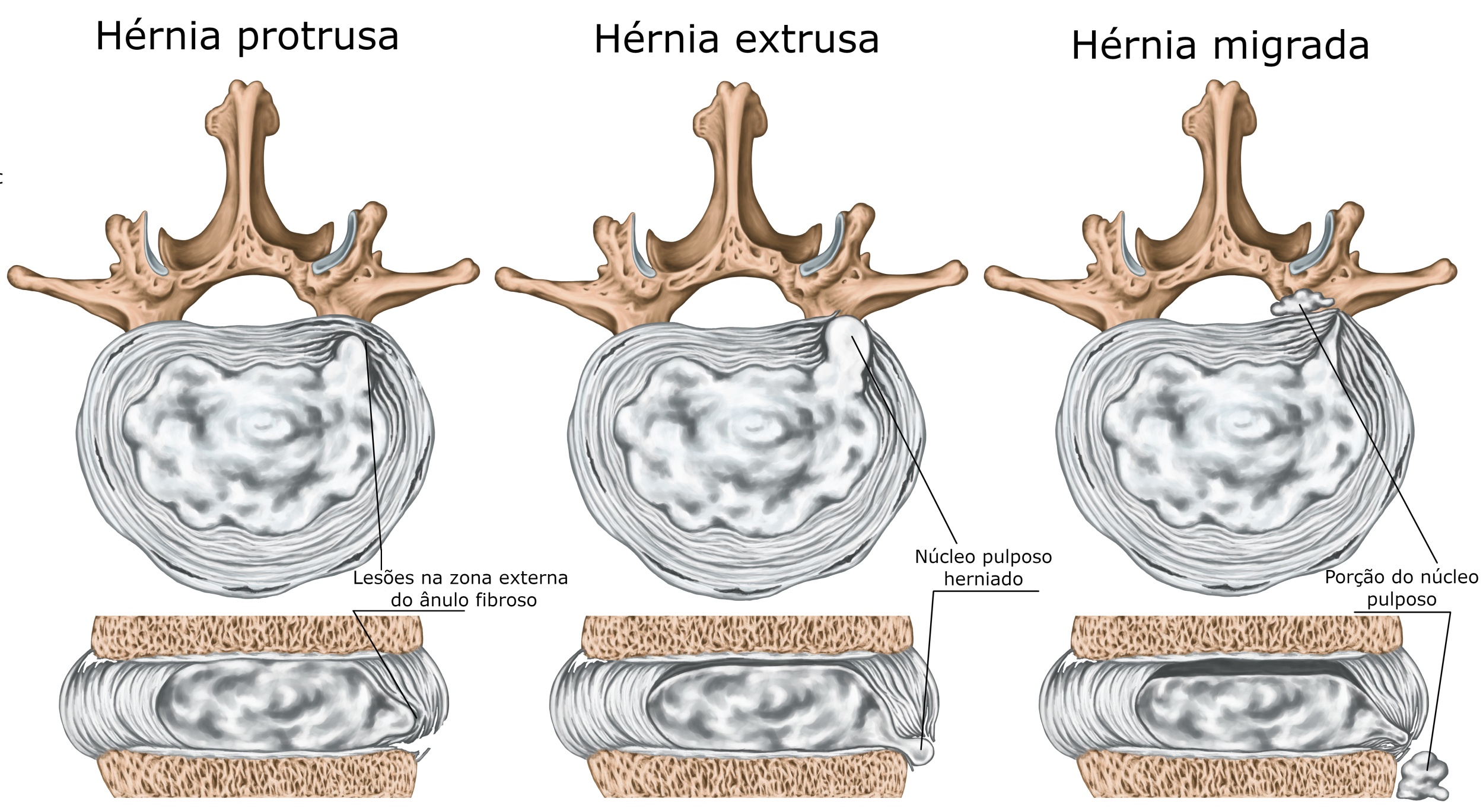 Se puede correr con hernia discal