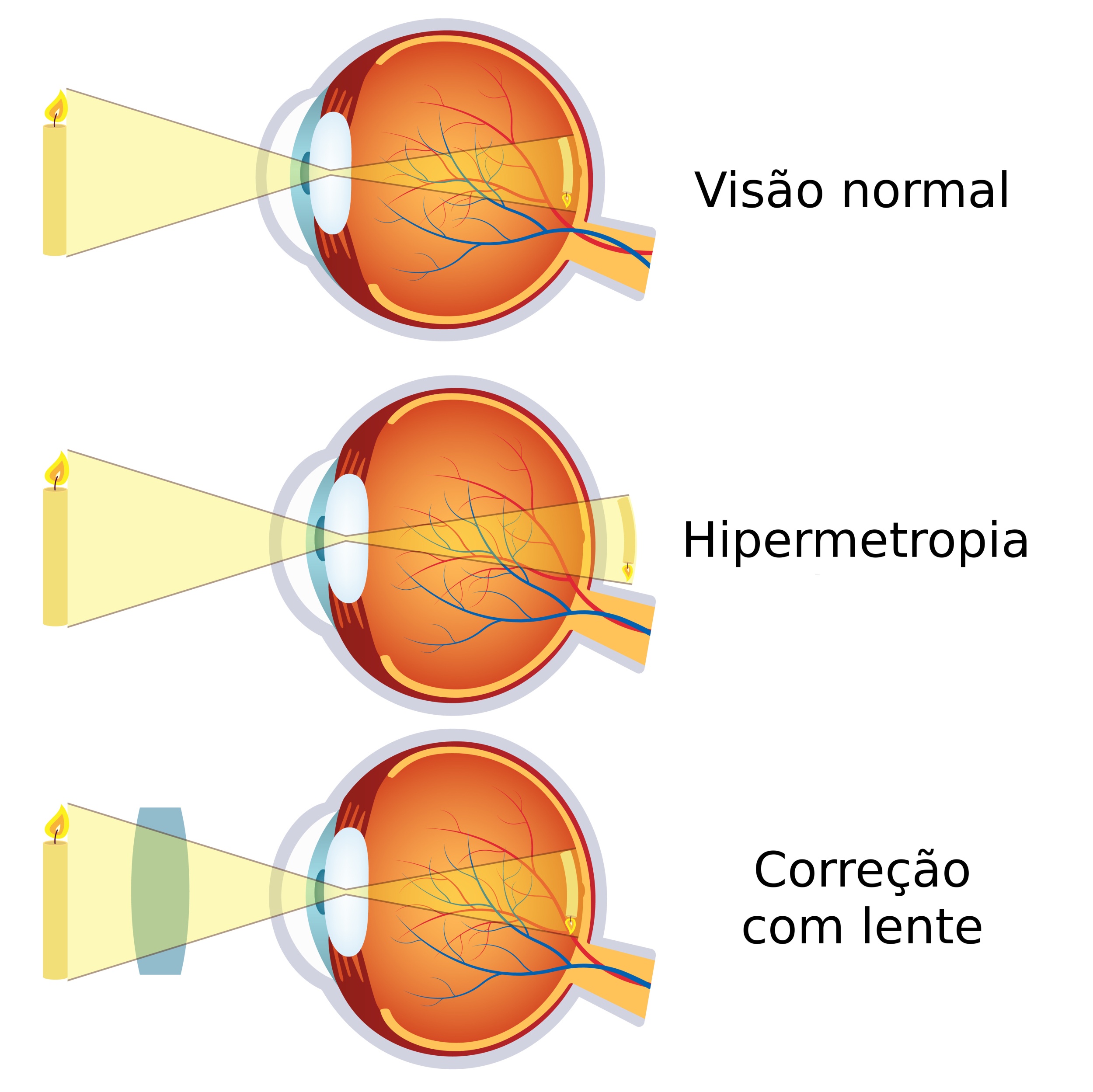 hipermetropia de gradul II viziune minus trei