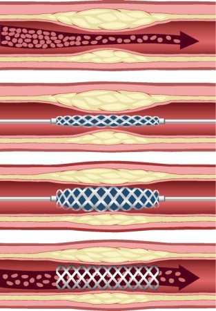 Implante de um stent cardíaco. Ilustração: anemad / Shutterstock.com