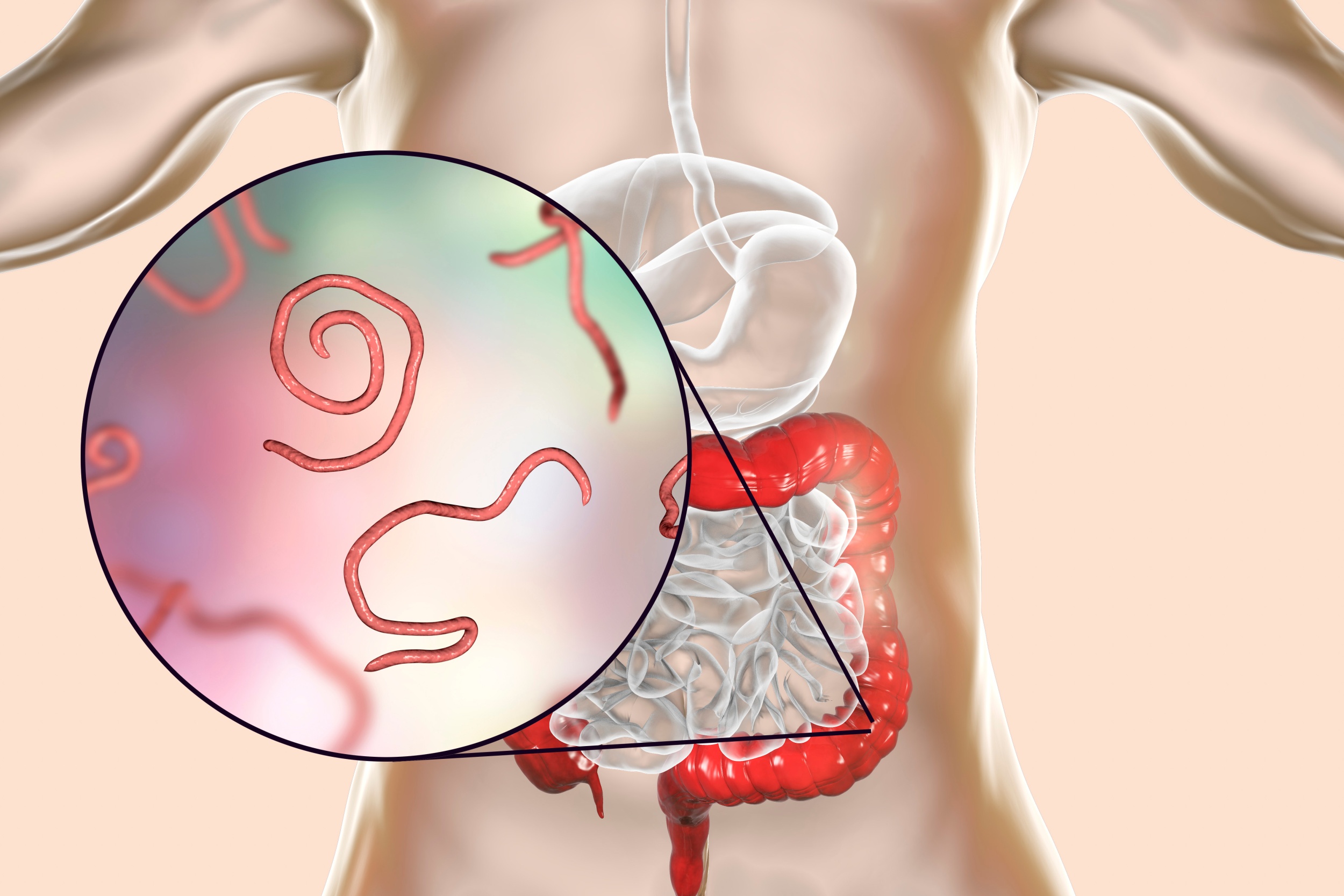 enterobiasis que es hpv impfung jungen gegner