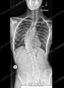 escoliose neuromuscular