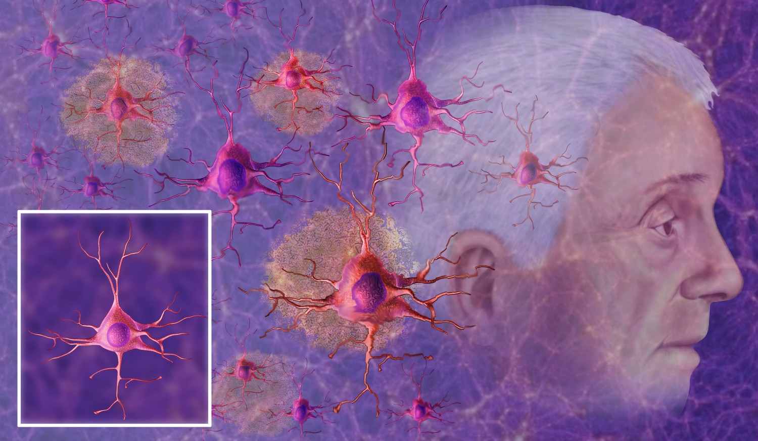 Resultado de imagem para DOENÃ‡AS NEURODEGENERATIVAS