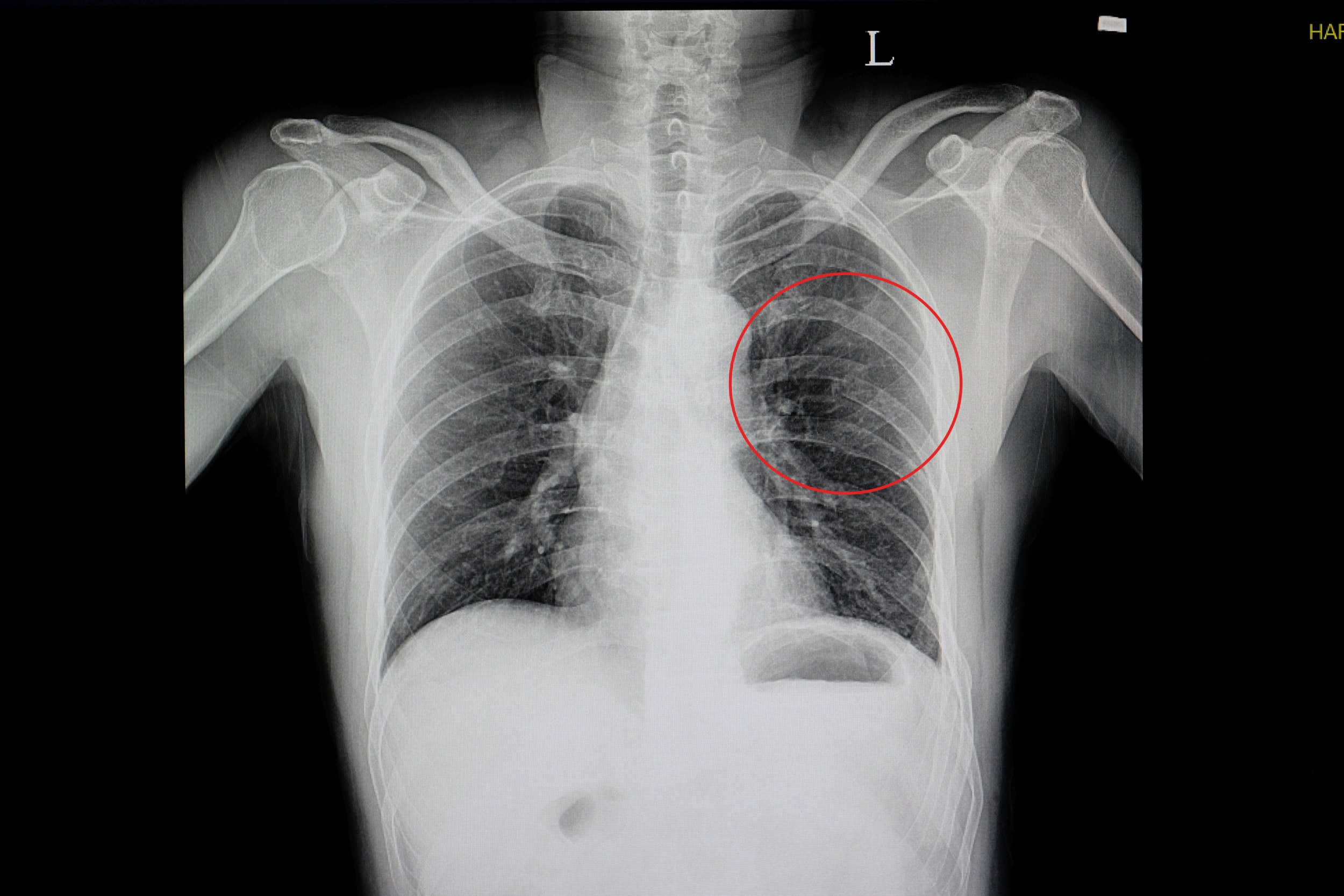 tratament articular costal