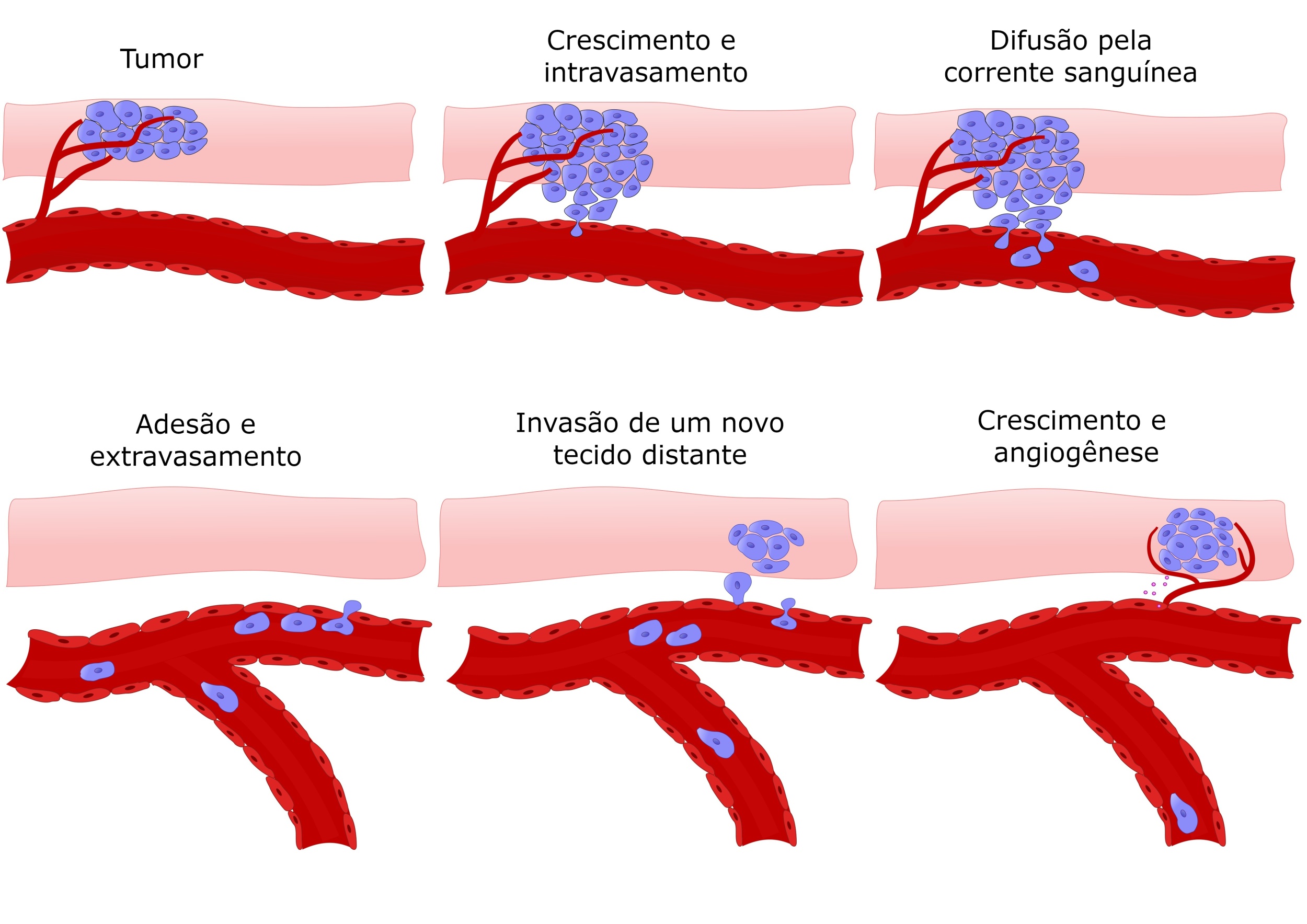 metastaza prostata)